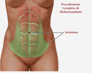 abdominoplastia 1 (1)